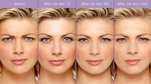 botox-before-and-after-photos